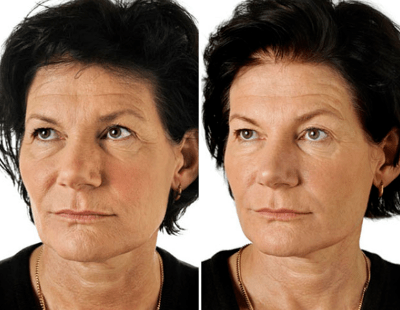 Výsledek zlomkové omlazení obličeje