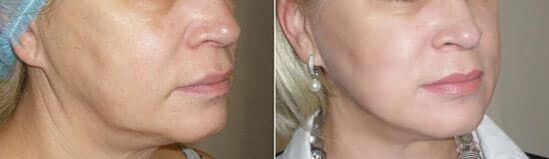 Fotografie po aplikaci postupu