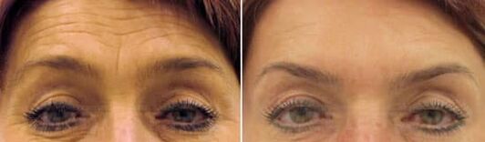 Omlazení pole na čele